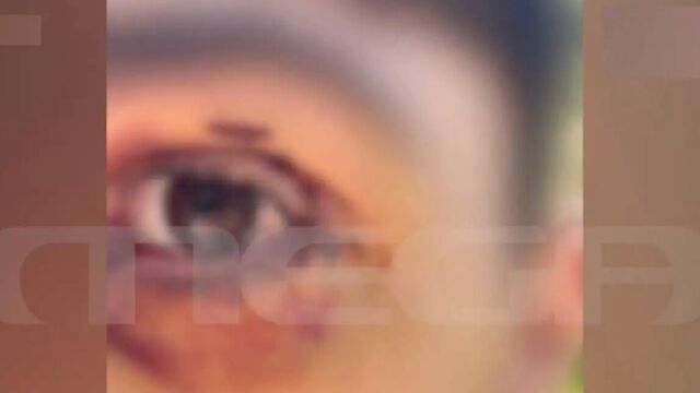 Ιωάννινα: Έστησαν καρτέρι σε 16χρονο τον ξυλοκόπησαν άγρια και κινδύνευσε να χάσει την όρασή του - Ο δράστης έλεγε έβλεπα τα αίματα και τρελαινόμουν  (Βίντεο)