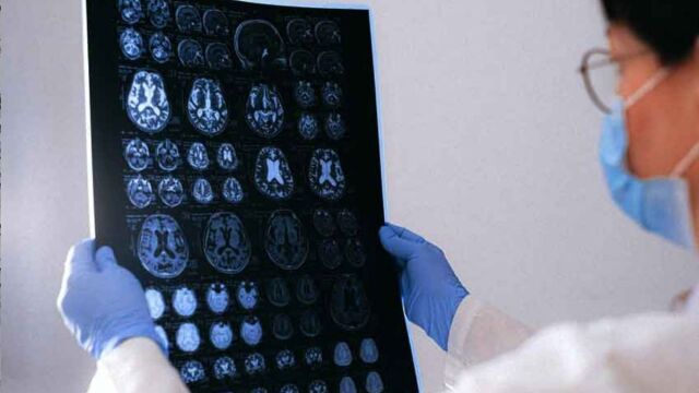 Aνεύρυσμα εγκεφάλου: Η εξέταση που μπορεί να μας σώσει τη ζωή