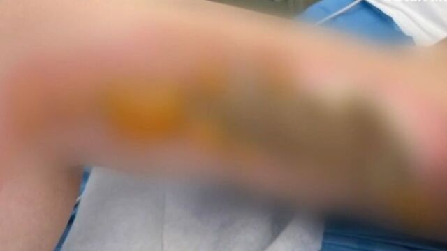 Θεσσαλονίκη: Πήγε στο νοσοκομείο για κύστη κόκκυγος και κατέληξε με εγκαύματα - Δεν ξέρω αν θα μπορέσω να ξαναδουλέψω (Βίντεο)