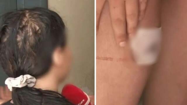 Καλλιθέα: Ζήλευε πολύ, έχει εμμονή μαζί μου, λέει η 19χρονη που έπεσε θύμα επίθεσης από τον 18χρονο πρώην σύντροφό της (Βίντεο)